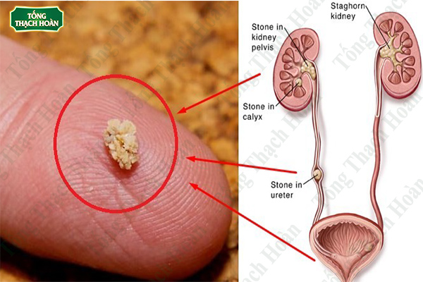 Kích thước và vị trí sỏi