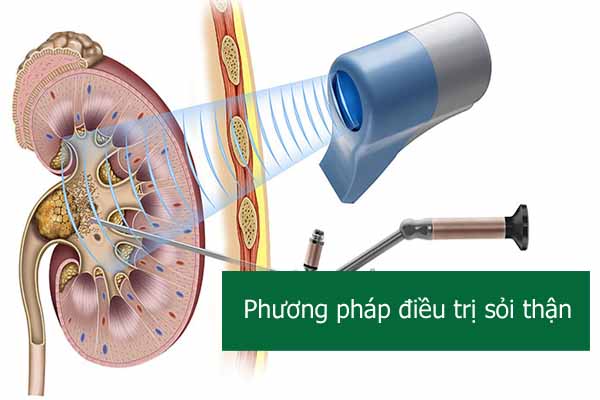 n phuong phap dieu tri soi than 1