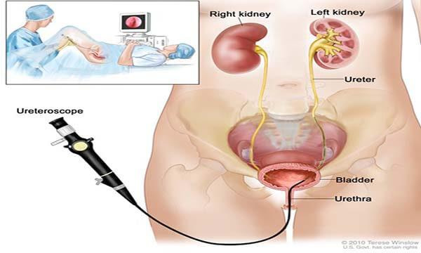 Nội soi niệu quản là phương pháp hiện đại được áp dụng phổ biến