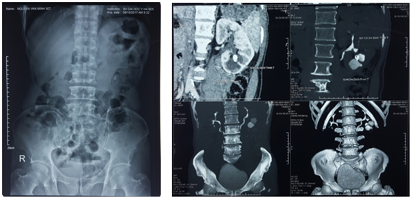 Sỏi thận đài dưới gây kẹt cổ đài, ứ nước đài đưới thận T