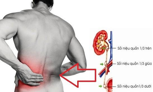 Sỏi niệu quản sẽ gây nhiều biến chứng nguy hiểm nếu không được điều trị