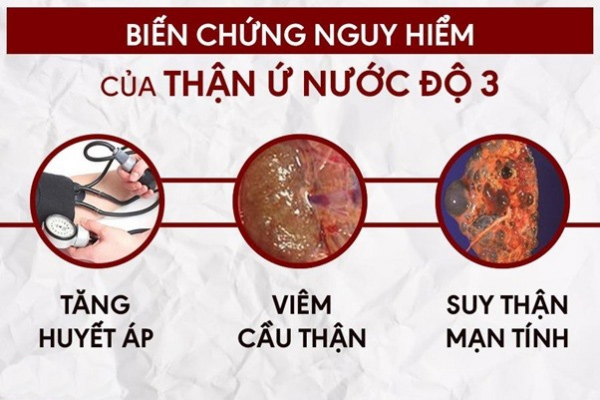 Hình ảnh các giai đoạn của biến chứng ứ nước tại thận do sỏi