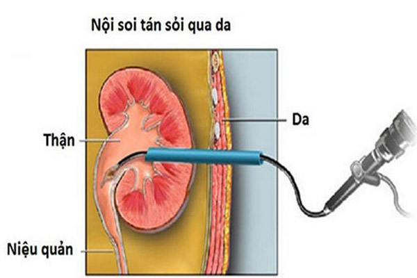 soi than 4mm 1