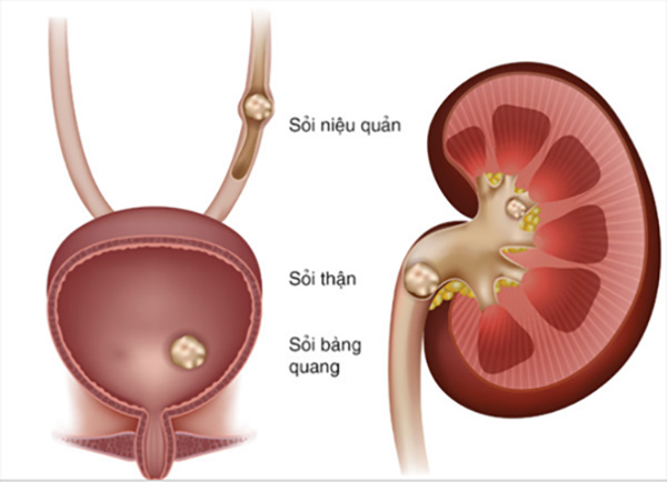 Sỏi ở các vị trí trên đường tiết niệu.