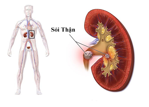 Sỏi thận 10mm