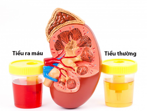 Sau khi tán sỏi đi tiểu ra máu - Nguyên nhân, triệu chứng và biện pháp khắc phục