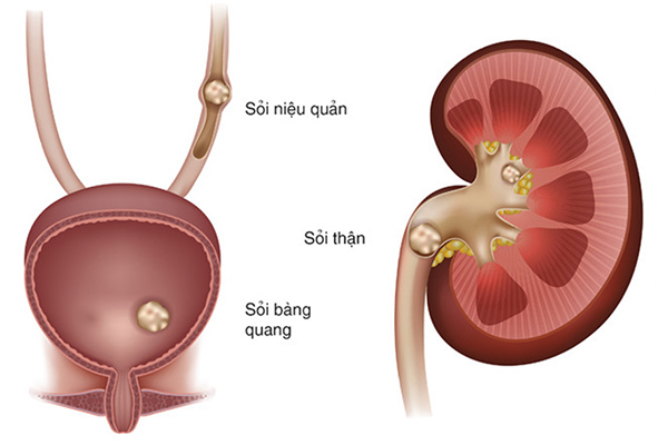 Vị trí sỏi thận